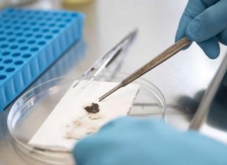 Descubren múltiples variantes de ADN que influyen en la esclerosis múltiple