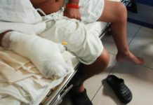 Dos menores y un adulto ingresan a hospital sampedrano con quemaduras por pólvora