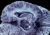 Negros e hispanos de ascendencia caribeña con más riesgo de infarto cerebral
