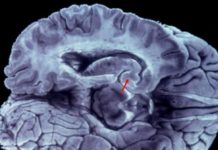 Negros e hispanos de ascendencia caribeña con más riesgo de infarto cerebral