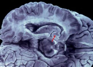 Negros e hispanos de ascendencia caribeña con más riesgo de infarto cerebral