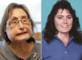 Muere mujer que recibió primer trasplante facial en EE.UU