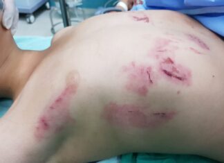 Niño de 11 años, otro paciente más que llega por quemadura de pólvora