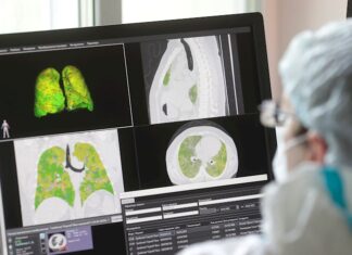 La covid-19 podría causar anomalías pulmonares meses después del contagio pulmones