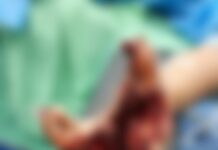 Llega otra persona al HEU con herida grave tras manipular pólvora