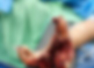 Llega otra persona al HEU con herida grave tras manipular pólvora