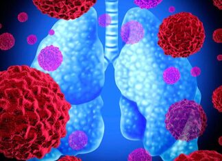 Inmunoterapia es una esperanza de vida para pacientes con cáncer de pulmón