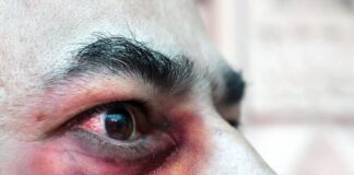 ¿Qué es el peligroso Hongo Negro y por qué alarma al mundo en la pandemia?