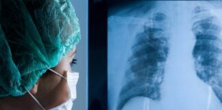 ¡Alarmante! Jóvenes contagiados de covid-19 reportan un 90% de afectación pulmonar