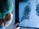 ¡Alarmante! Jóvenes contagiados de covid-19 reportan un 90% de afectación pulmonar