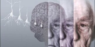 Nuevo fármaco para el alzhéimer debería entusiasmar a los enfermos