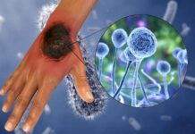 El hongo negro ya existía en Honduras según autoridades de Salud