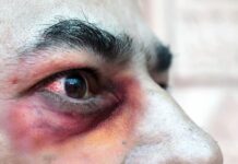 Detectan segundo caso de Hongo Negro post COVID en SPS