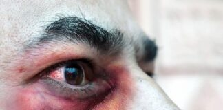 Detectan segundo caso de Hongo Negro post COVID en SPS