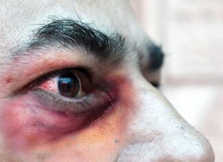 Detectan segundo caso de Hongo Negro post COVID en SPS