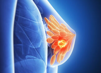 Un fármaco puede ayudar ante la resistencia al principal tratamiento de un cáncer de mama