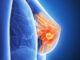 En un 60% aproximadamente se encuentra la mortalidad por cáncer de mama en Honduras, según Oncólogo