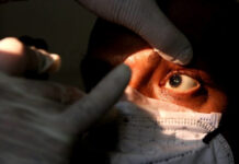 Salud confirma el tercer caso de Hongo Negro post Covid-19 en Honduras