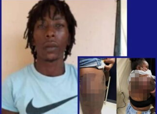 Un hombre le roció ácido de batería en el cuerpo a su expareja, ocasionándole graves quemaduras, en la zona norte del país