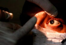 Autoridades de salud confirman ocho casos de Hongo Negro en Honduras