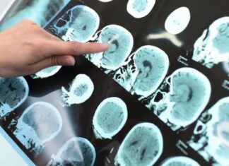 Detectan el primer caso de «síndrome del ano inquieto» como consecuencia del Covid-19