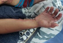 Fundaniquem ha atendido unos 400 niños con quemaduras durante la pandemia