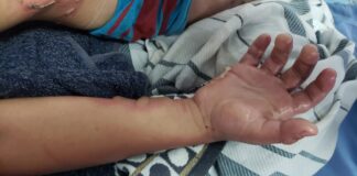 Médico hondureño culpa a padres de familia por cada niño quemado por pólvora