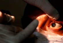 Suben a 25 los casos de hongo negro en Honduras