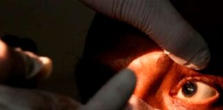 Suben a 25 los casos de hongo negro en Honduras