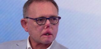 Hombre pierde sus dedos, piernas y parte de su cara por una lamida de su perro