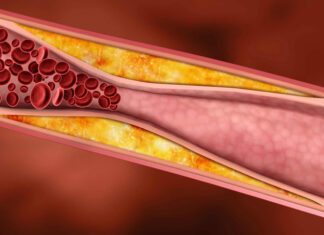 Disminuir niveles de colesterol «malo» evitaría desarrollo de aterosclerosis
