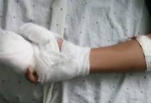 Menor pierde dos dedos de mano derecha por quemadura con pólvora