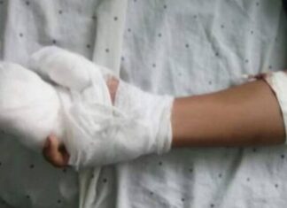 Menor pierde dos dedos de mano derecha por quemadura con pólvora