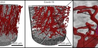 El Covid-19 puede crear daños vasculares en el corazón