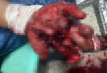Hombre pierde dos dedos de su mano derecha tras manipular un mortero en la capital