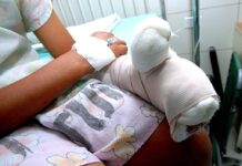 Niña de 11 años pierde una de sus manos tras la explosión de un mortero en Copán