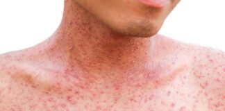 Más de la mitad de los países sufrirán alto riesgo de brotes de sarampión este año, según la OMS