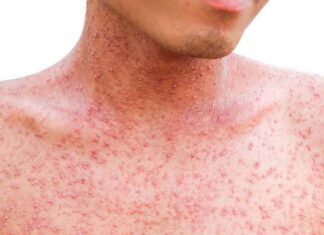 Más de la mitad de los países sufrirán alto riesgo de brotes de sarampión este año, según la OMS