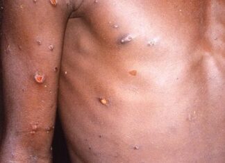 Honduras se declara en vigilancia permanente ante amenaza de la “viruela del mono”