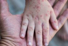 La Sesal asegura estar lista en caso de detectarse algún caso de la viruela del mono en Honduras