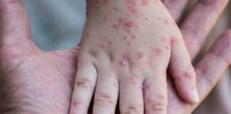 La Sesal asegura estar lista en caso de detectarse algún caso de la viruela del mono en Honduras