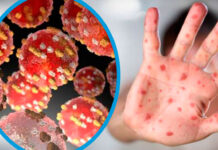 Detectan dos primeros casos sospechosos de viruela del mono en Corea del Sur