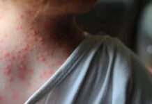 Especialistas piden vigilar los aeropuertos de Honduras para evitar los casos de viruela del mono