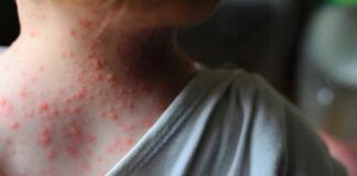 Especialistas piden vigilar los aeropuertos de Honduras para evitar los casos de viruela del mono