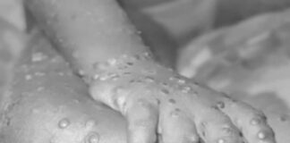 Argentina confirma el primer caso de viruela del mono en América Latina