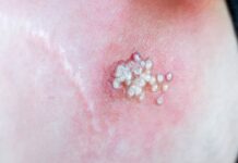 Viruela del mono no es una enfermedad de transmisión sexual ni exclusiva de personas LGBTI, aclara galena