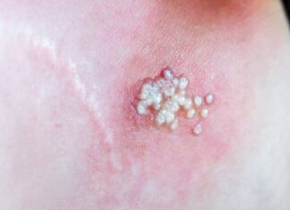 Viruela del mono no es una enfermedad de transmisión sexual ni exclusiva de personas LGBTI, aclara galena