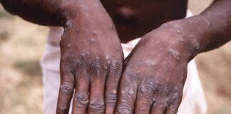 La OMS anticipa que aparecerán más casos de la viruela del mono