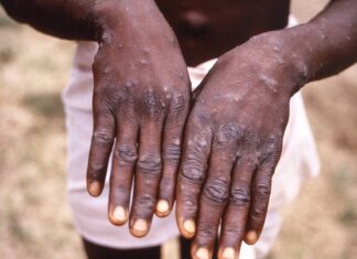 La OMS anticipa que aparecerán más casos de la viruela del mono