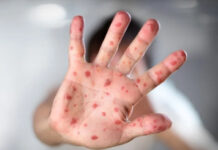 Viruela del mono, un virus en expansión con posibilidades de llegar a Honduras